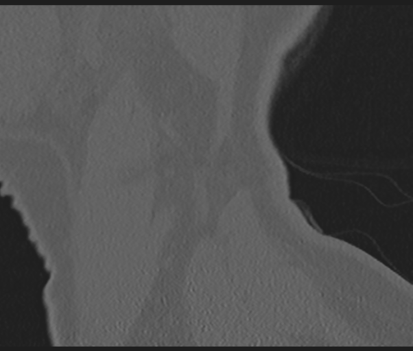 File:Cervical disc replacement (Radiopaedia 44025-47541 Sagittal bone window 79).png
