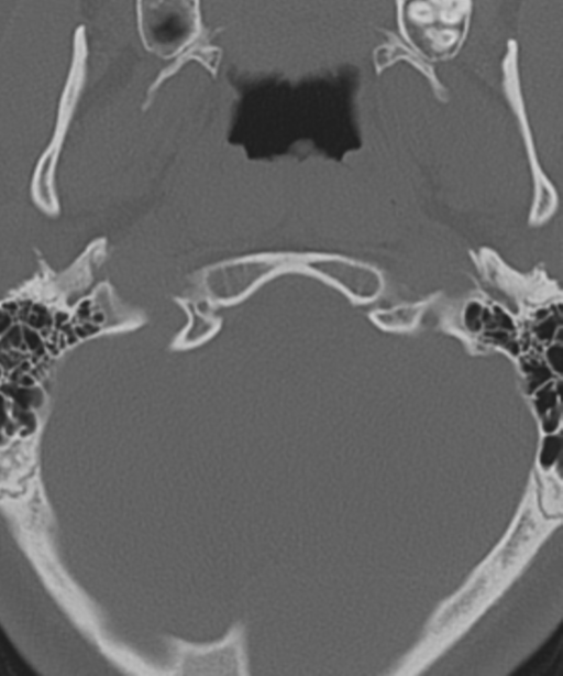 Cervical intercalary bone (Radiopaedia 35211-36748 Axial bone window 7).png