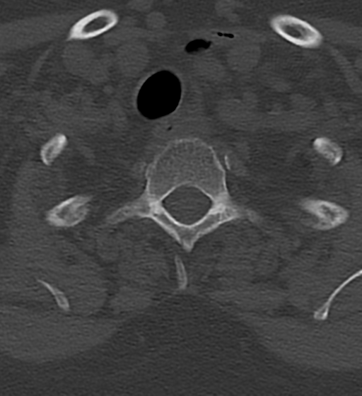 Cervical spine ACDF loosening (Radiopaedia 48998-54070 Axial bone window 56).png