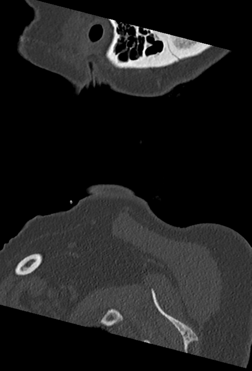 Cervical spine ACDF loosening (Radiopaedia 48998-54070 Sagittal bone window 2).png