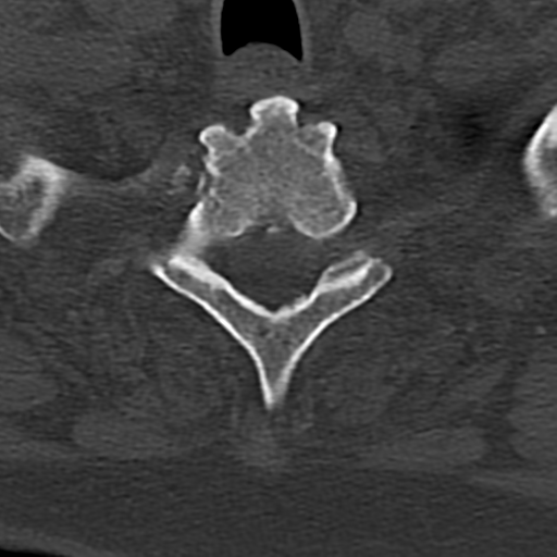 Cervical spine fracture - chalk stick (Radiopaedia 39116-41323 Axial bone window 84).png
