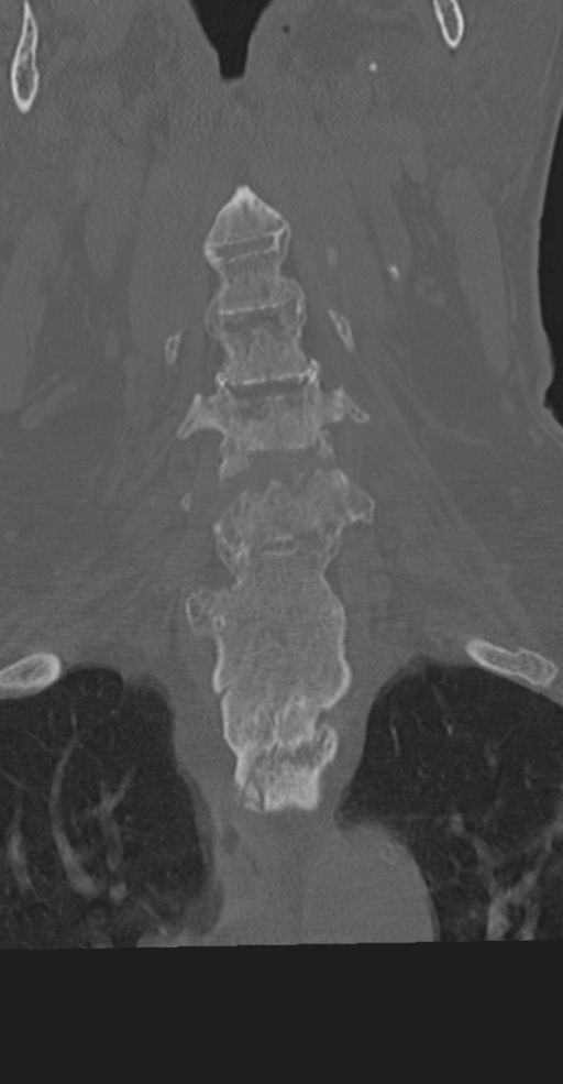 Cervical spine fracture in the setting of ankylosis (Radiopaedia 37038-38715 Coronal bone window 25).png