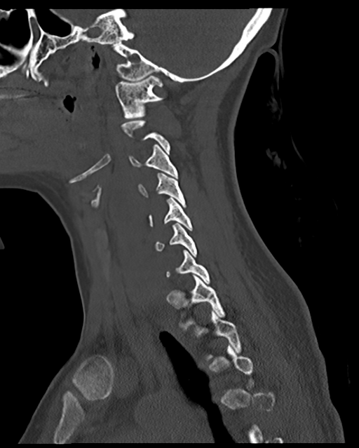 Cervical tuberculous spondylitis (Radiopaedia 39149-41365 Sagittal bone window 24).png