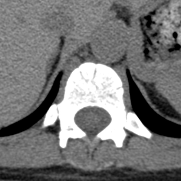File:Chance fracture (Radiopaedia 36521-38081 Axial non-contrast 53).jpg