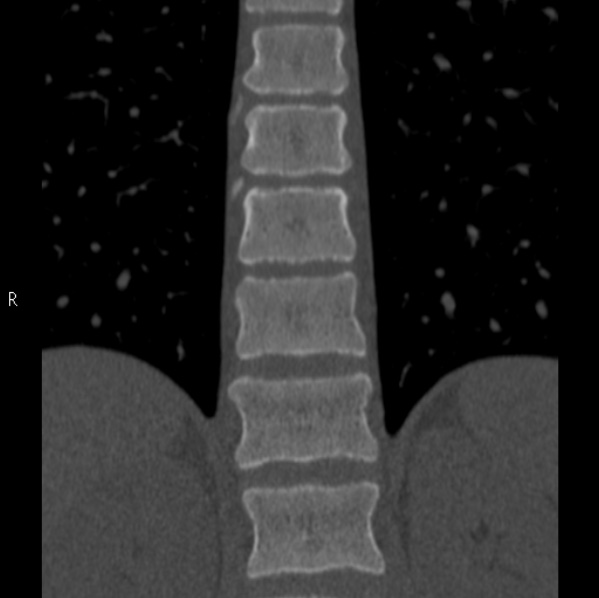 File:Chance fracture (Radiopaedia 36521-38081 Coronal bone window 27).jpg