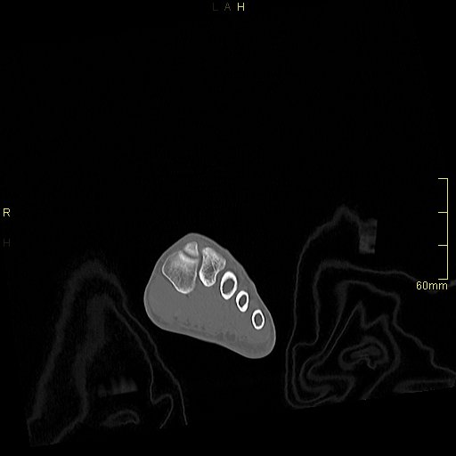 Chaput tubercle fracture (Radiopaedia 80319-93956 Coronal non-contrast 4).jpg