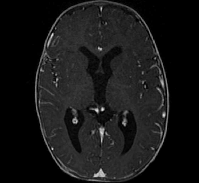 Chiasmatic-hypothalamic glioma (Radiopaedia 90079-107252 Axial T1 C+ 44).jpg