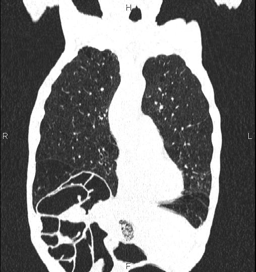 Chilaiditi sign (Radiopaedia 88839-105611 Coronal lung window 18).jpg