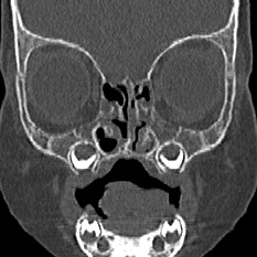 Choanal atresia (Radiopaedia 88525-105975 Coronal bone window 30).jpg