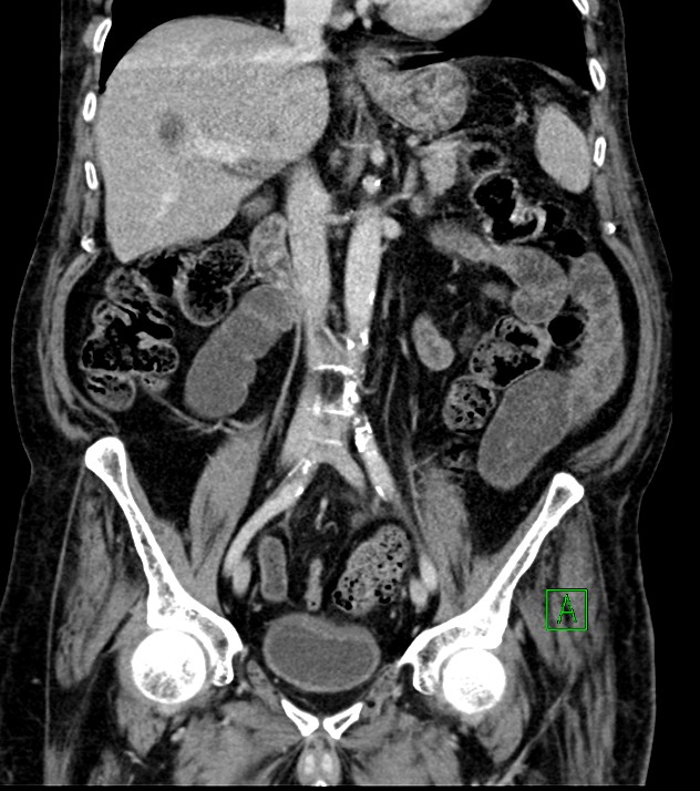 Cholangiocarcinoma with cerebral metastases (Radiopaedia 83519-98629 G 42).jpg