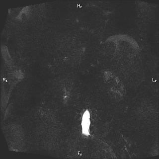 Choledochal cyst - type Ia (Radiopaedia 85673-101454 F 84).jpg