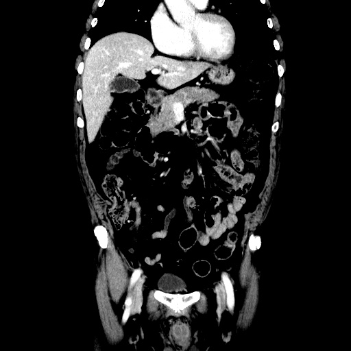 Choledocholiathiasis with normal caliber common bile duct (Radiopaedia 75368-86632 Coronal liver window 50).jpg