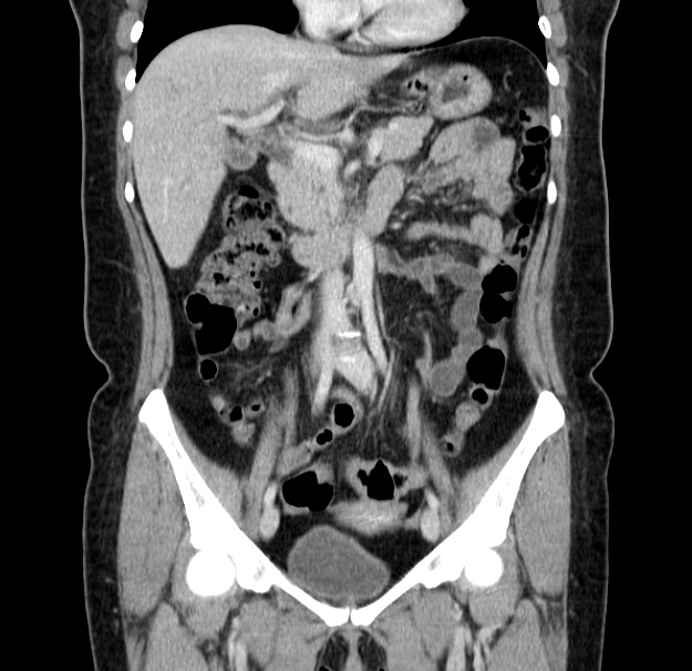 Choledocholithiasis on CT and MRI (Radiopaedia 24825-25087 C 22).jpg