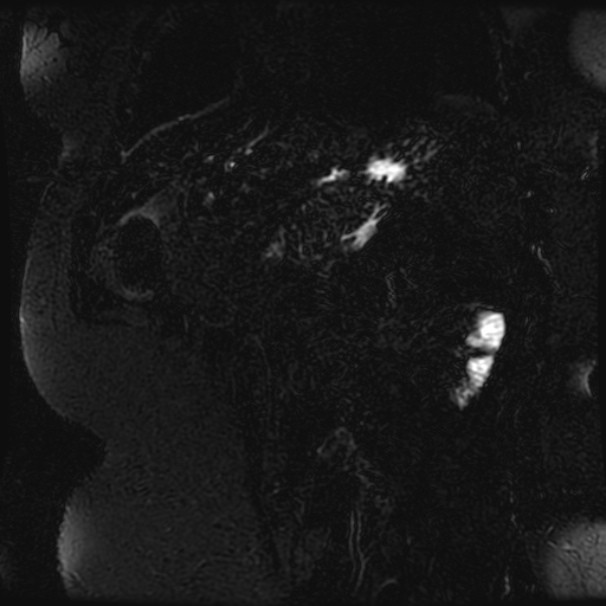Choledocholithiasis on CT and MRI (Radiopaedia 24825-25088 Coronal T2 92).jpg