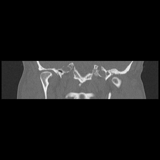 Cholesteatoma (Radiopaedia 84946-100455 Coronal bone window 89).jpg