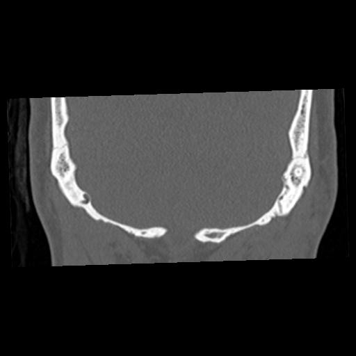 Cholesteatoma (Radiopaedia 84960-100474 Coronal bone window 68).jpg