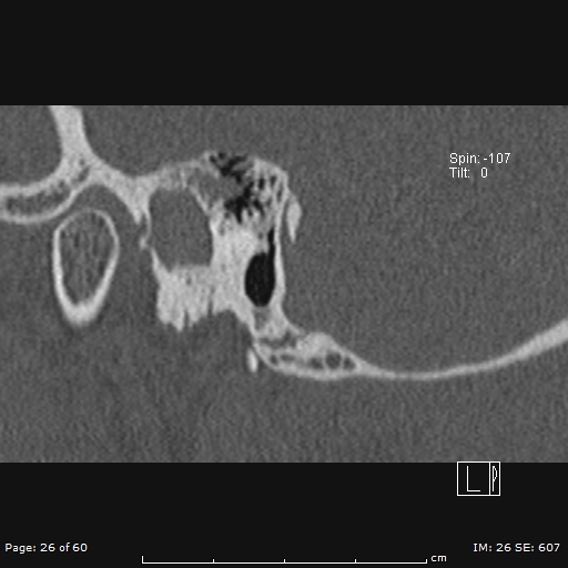 Cholesteatoma - external auditory canal (Radiopaedia 88452-105096 Sagittal bone window 26).jpg