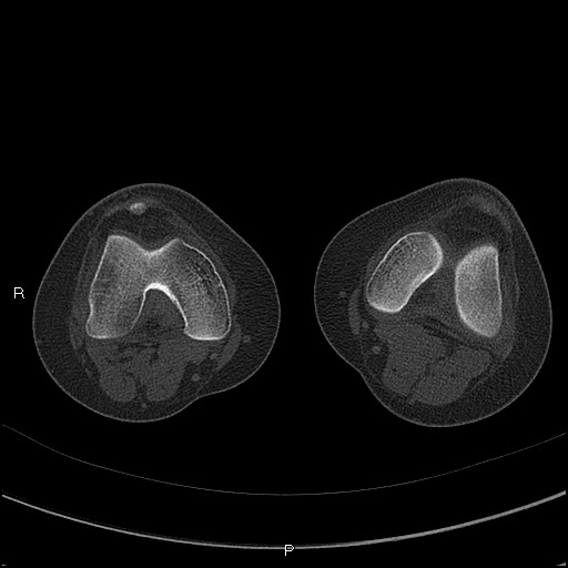 Chondroblastoma (Radiopaedia 62721-71030 Axial bone window 24).jpg