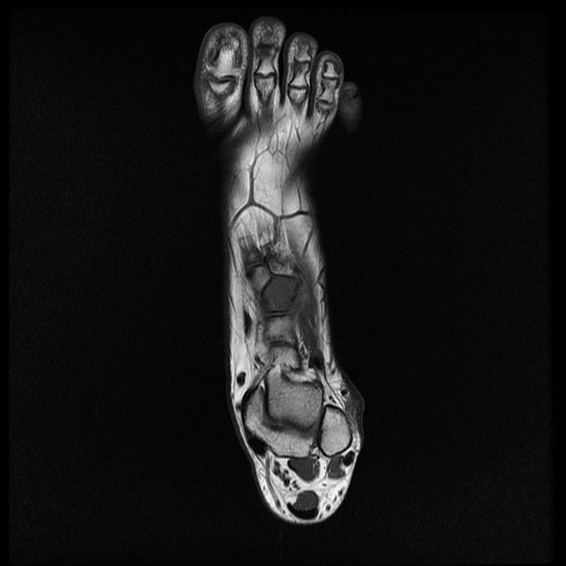 File:Chondroblastoma - midfoot (Radiopaedia 64831-73765 Long axis T1 17).jpg