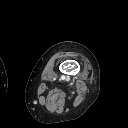 Chondrosarcoma - femur (Radiopaedia 64187-72954 Axial with contrast 14).jpg