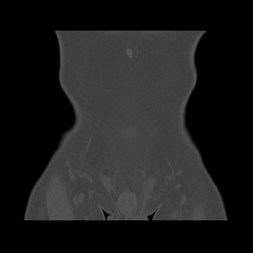 Chondrosarcoma of iliac wing (Radiopaedia 63861-72599 Coronal bone window 20).jpg