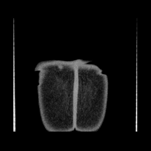 File:Chondrosarcoma of iliac wing (Radiopaedia 63861-72599 Coronal non-contrast 115).jpg