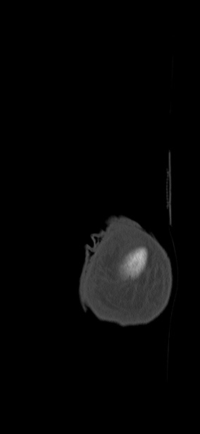 Chopart fracture (Radiopaedia 35347-36851 Coronal bone window 1).jpg
