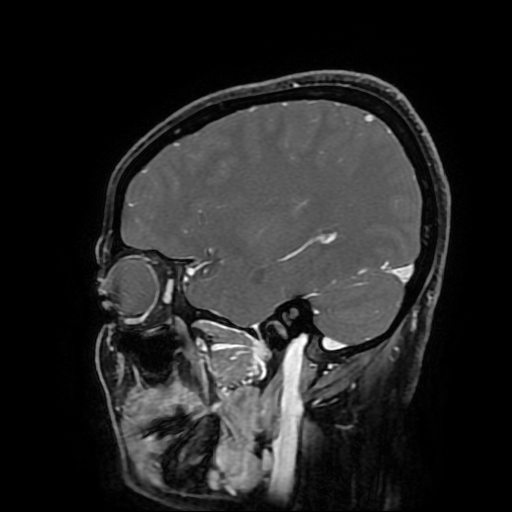 Chordoid glioma of third ventricle (Radiopaedia 91612-109340 F 65).jpg