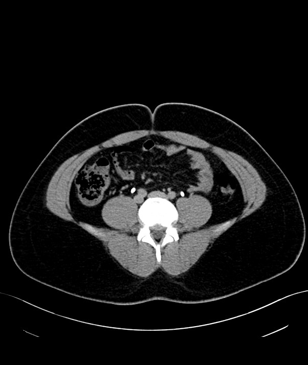 Chromophobe renal cell carcinoma (Radiopaedia 84255-99542 H 35).jpg