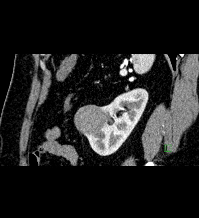 Chromophobe renal cell carcinoma (Radiopaedia 84286-99573 F 40).jpg