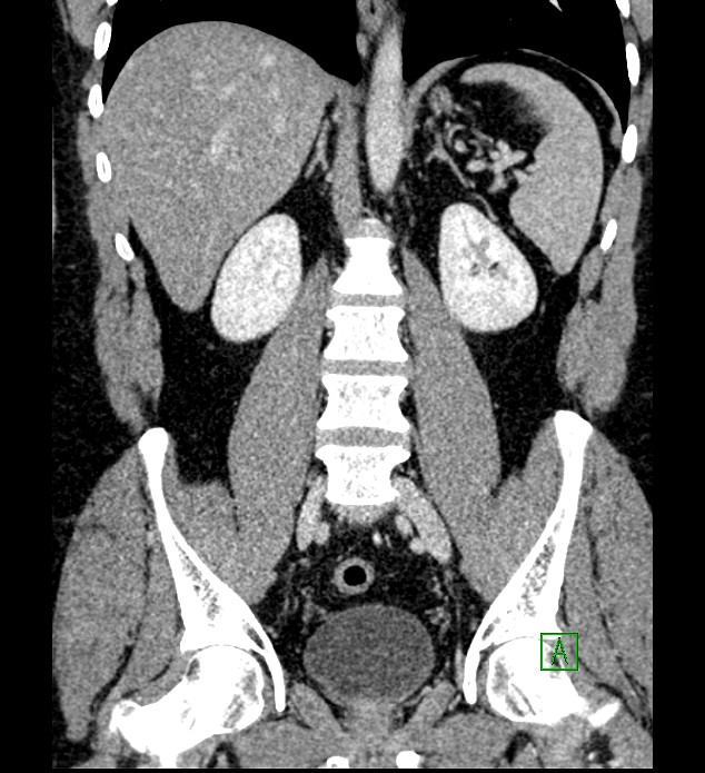Chromophobe renal cell carcinoma (Radiopaedia 84286-99573 H 112).jpg