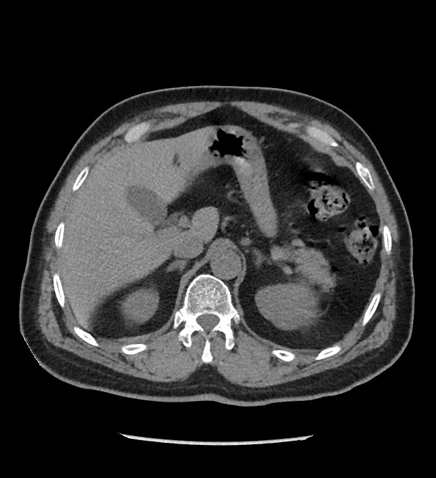 Chromophobe renal cell carcinoma (Radiopaedia 86879-103083 Axial non-contrast 17).jpg