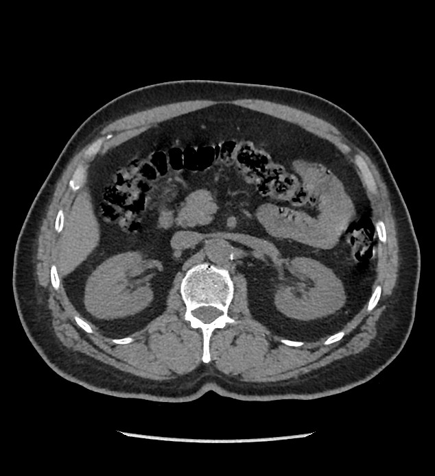 Chromophobe renal cell carcinoma (Radiopaedia 86879-103083 Axial non-contrast 34).jpg