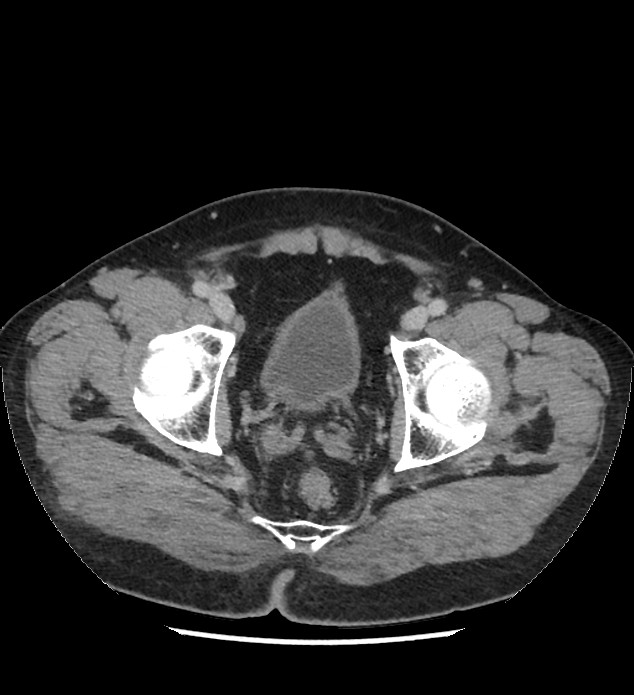 Chromophobe renal cell carcinoma (Radiopaedia 86879-103083 C 141).jpg