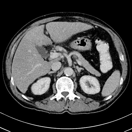 Chronic appendicitis complicated by appendicular abscess, pylephlebitis and liver abscess (Radiopaedia 54483-60700 B 52).jpg