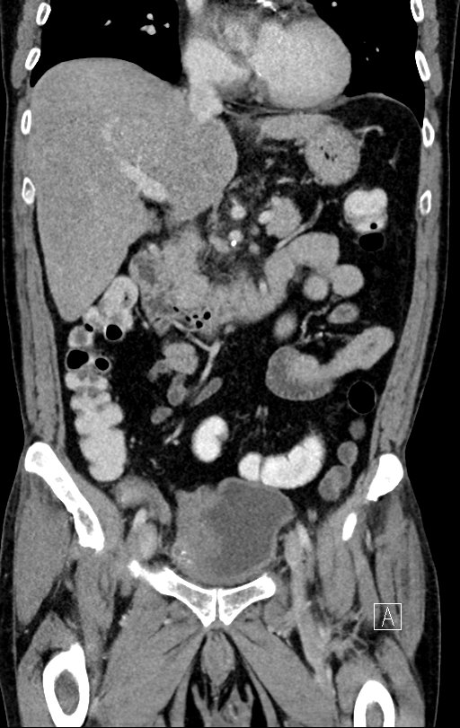 Chronic appendicitis complicated by appendicular abscess, pylephlebitis and liver abscess (Radiopaedia 54483-60700 C 36).jpg