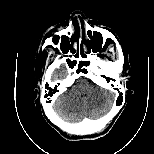 Chronic invasive fungal sinusitis (Radiopaedia 91563-109286 Axial non-contrast 18).jpg