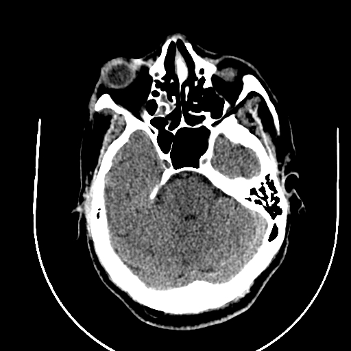 File:Chronic invasive fungal sinusitis (Radiopaedia 91563-109286 Axial non-contrast 27).jpg