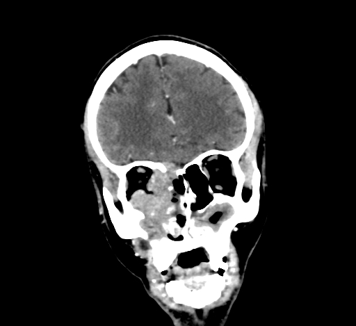 Chronic invasive fungal sinusitis with intraorbital and intracranial extension (Radiopaedia 56387-63046 C 106).jpg