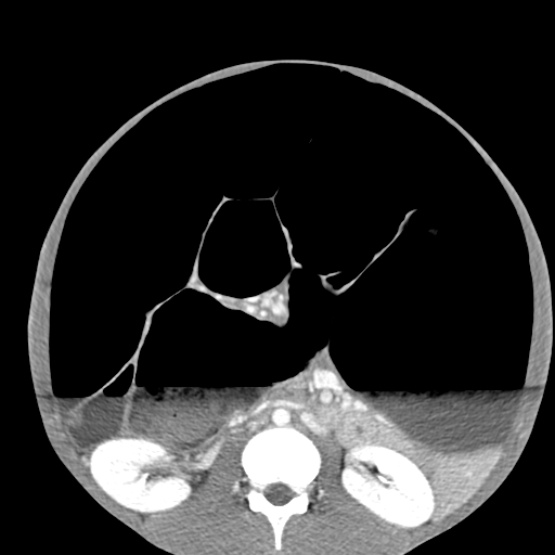 Chronic large bowel pseudo-obstruction (Radiopaedia 43181-46492 A 91).jpg