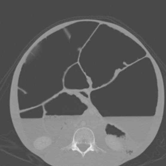 Chronic large bowel pseudo-obstruction (Radiopaedia 43181-46492 Axial bone window 100).jpg