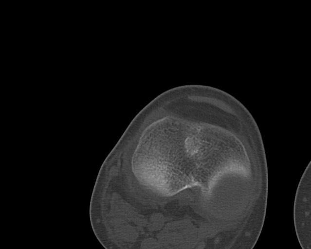 File:Chronic ostemyelitis of the femur with long sinus tract (Radiopaedia 74947-85982 Axial bone window 232).jpg
