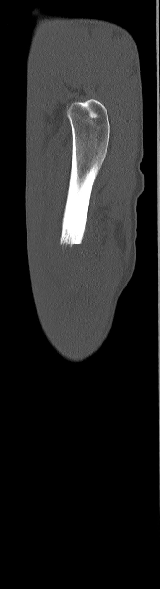 Chronic osteomyelitis (with sequestrum) (Radiopaedia 74813-85822 C 100).jpg