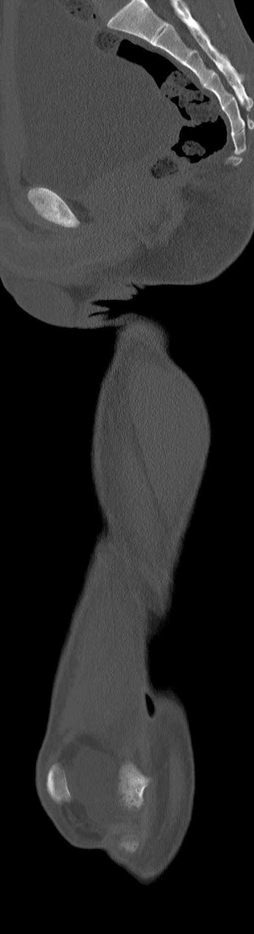 Chronic osteomyelitis (with sequestrum) (Radiopaedia 74813-85822 C 59).jpg