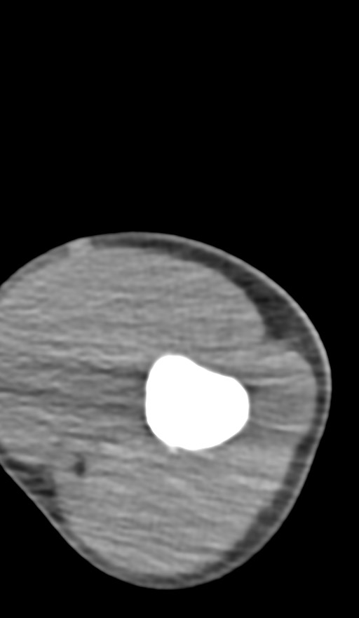 Chronic osteomyelitis of the distal humerus (Radiopaedia 78351-90971 Axial non-contrast 52).jpg