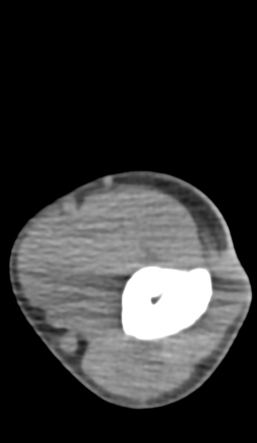 Chronic osteomyelitis of the distal humerus (Radiopaedia 78351-90971 Axial non-contrast 70).jpg