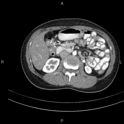 File:Chronic pancreatitis (Radiopaedia 64576-73450 B 72).jpg