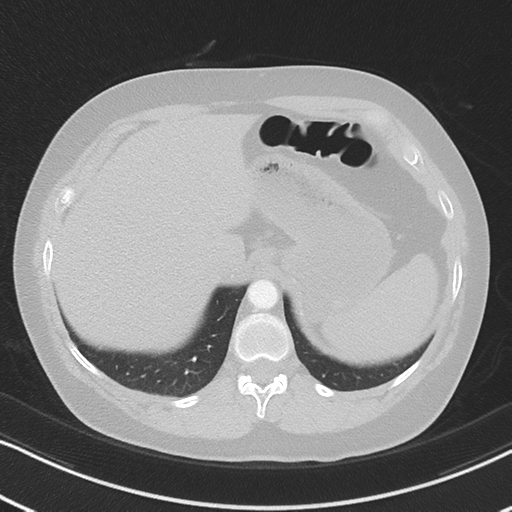 File:Chronic pulmonary embolus (Radiopaedia 39129-41341 Axial lung window 55).png