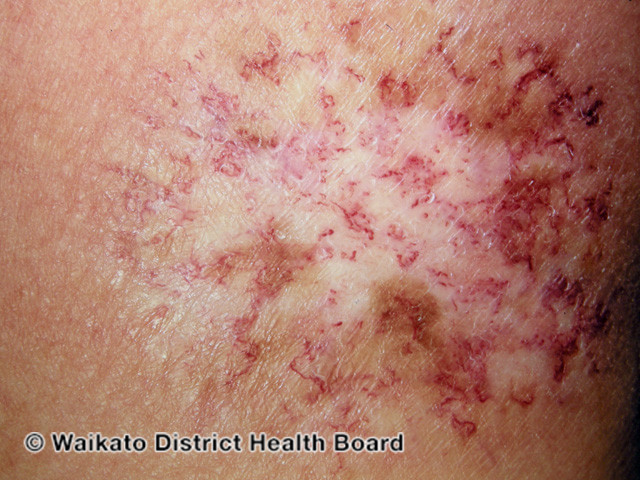 File:Chronic radiation dermatitis (DermNet NZ reactions-w-radiation-dermatitis3).jpg