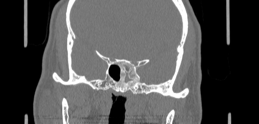 Chronic sphenoidal sinusitis (Radiopaedia 62030-70122 Coronal bone window 121).jpg